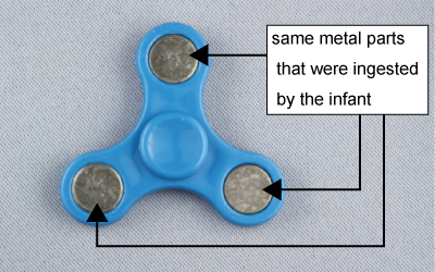 Photo showing the same metal parts that were ingested by the infant