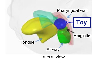 Intraoral illustration in the status of suffocation due to pharyngeal obstruction