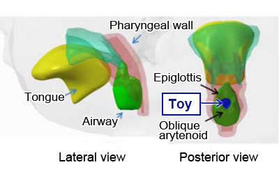 Intraoral illustration in the status of suffocation due to laryngeal obstruction