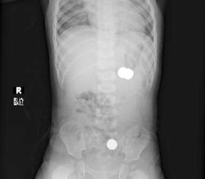 Photo of the infant's abdominal X-ray