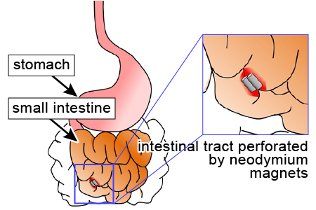Illustration of stomach and intestine when intestinal tract is perforated by neodymium magnets