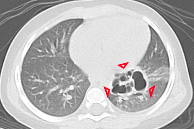 肺の一部に空洞影が写った横断面のCT画像