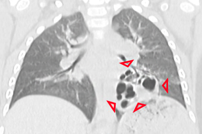 肺の一部に空洞影が写った縦断面のCT画像