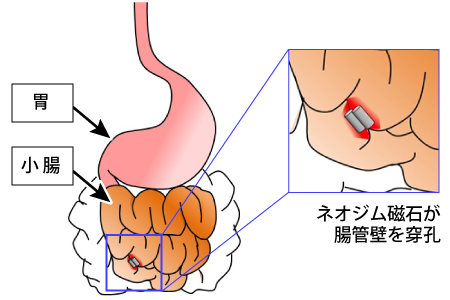 胃や小腸のイラストと誤飲したネオジム磁石が腸管壁に穴をあけているイメージ図