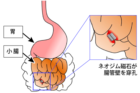 マグネットパズルの破損に注意 内蔵された強力な磁石を誤飲した幼児の胃や腸に穴があく事故が発生 発表情報 国民生活センター